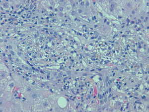 Liver biopsy. Haematoxylin–eosin staining.