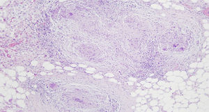 Necrotising granulomas, with central caseous necrosis surrounded by multinucleated giant cells.