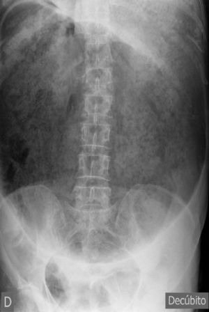 Severe gastric dilatation on conventional abdominal X-ray.