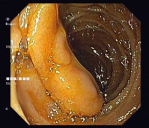 Upper endoscopy: 3cm pedunculated subepithelial lesion in duodenum.