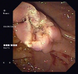 Upper endoscopy: post resection of the subepithelial lesion.