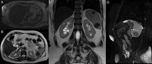 Magnetic resonance imaging. (A) T2-weighted sequences (axial plane) showing a vascular structure in the splenic hilum with a nodular configuration. A macronodular lesion is also seen in this image, within the spleen, exhibiting low signal. (B and C) T2-weighted sequences (axial and coronal plane, respectively) showing nodular lesions, in the upper spleen and the lower spleen, with lobular borders, hypointense, sketching internal micronodular formations. (D) Fiesta FATSAT (sagittal plane) sequence showing a hypointense lesion in the lower spleen, with discrete hyperintense septa.