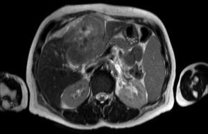 Liver MRI, T1-weighted image, showing the presence of hepatic capsular retraction.