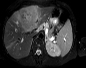 Liver MRI, T2-weighted image, showing the presence of dilatation of the intrahepatic bile duct.