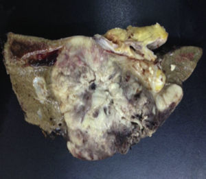 Liver mass with an infiltrative neoplastic appearance with necrosis and haemorrhage.