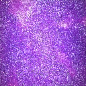 Nodular and diffuse lymphocytic neoplasm (haematoxylin–eosin staining 40×).