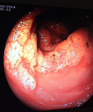Rectoscopy: circumferential ring in mid-rectum with an erosive polypoid appearance.