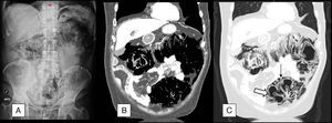 (A) Abdominal X-ray in standing position, in which extraluminal gas density can be seen surrounding the entire colon, as well as a discrete amount of subphrenic pneumoperitoneum. (B) Coronal reconstruction of abdominal CT with intravenous contrast. The scan confirms the existence of large areas of gas density surrounding the different colon segments. C) The lung window allows us to more accurately determine the location of the gas, which is both inside (⇒) and outside (→) the colon wall.
