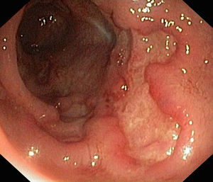 Extensive, deep ulcers with healthy interlesional mucosa along the entire length the colon.
