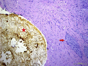 Histological image of the cystic duct with calculi (asterisk), fibrosis and hyperplasia of nerve plexuses (arrow).