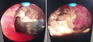 Endoscopic fragmentation of multiple gallstones in peripheral bile ducts, using the holmium laser.
