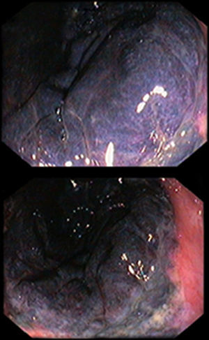 Case 1 proctosigmoidoscopy showing a purplish black rectal mucosa and edema.