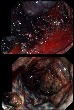Case 4 proctosigmoidoscopy showing dark blue friable rectal mucosa.