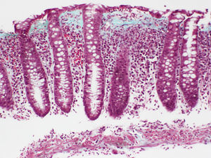 Collagenous colitis. Mucosa with normal crypt structure, showing increased inflammatory cellularity in the lamina propria. Dense collagen band below the surface epithelium including superficial capillaries, with irregular lower edge.