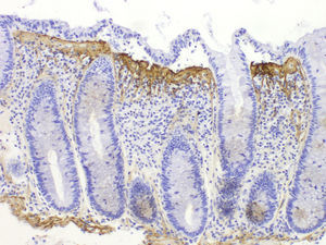 Collagenous colitis. Tenascin immunohistochemical staining. Note the subepithelial collagen band, which appears thicker and irregular, and frayed at the lower edge.