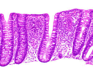 Lymphocytic colitis. Mucosa with normal structure, with increased inflammatory cellularity in the lamina propria and no subepithelial collagen accumulation, showing damage and disruption of the surface epithelium with marked transepithelial lymphocytic exocytosis.