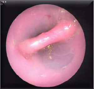View of the septum through the diverticuloscope.