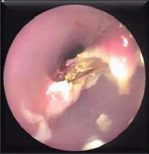 View of the dissected diverticular septum.