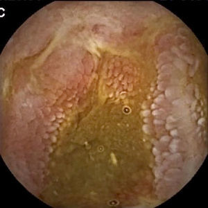 Inflammatory lesions in patients small bowel Crohn's disease.
