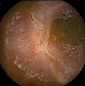Inflammatory lesions in patients small bowel Crohn's disease.