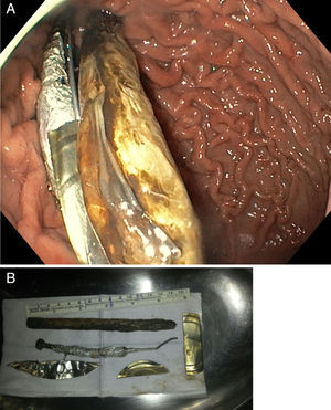 (A) Endoscopic view of gastric cavity containing the foreign bodies. (B) Foreign bodies.