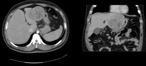 Axial and sagittal CT scan: adenoma located in left lateral segment.