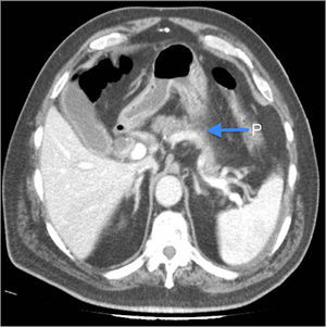 Abdominal CT scan. P: pancreatic oedema.