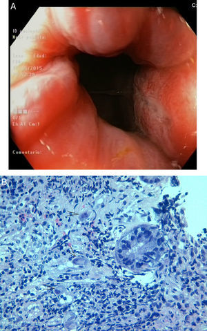 (A) Colonoscopy: aphthous ulcers in the terminal ileum. (B) Histological findings: enlargement of infected endothelial and stromal cells, with the presence of viral inclusion bodies (H&E staining).