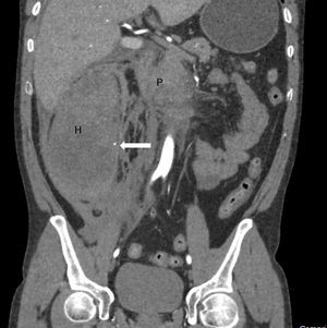 Abdominal CT scan Coronal plane. Arrow: arterial bleeding point for which embolization was attempted by interventional radiology; H: organized haematoma in the wall of the colon and mesocolon occupying the entire right flank; P: pancreatic head necrosis.