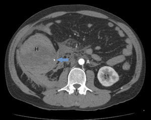 Abdominal CT scan Transverse plane. A: aorta. It can be seen here how the haematoma completely stenoses the intestinal lumen; Arrow: arterial bleeding point; H: haematoma.