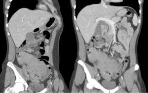 Extensive intestinal involvement, visible in the initial abdominal CT.