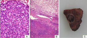 Histological block examination of the liver nodule before surgery. (A) Haematoxylin–eosin (H&E) staining in which groups of hepatocytes are observed with microacinar structures and irregular and thick hepatocyte trabeculae, comprising atypical hepatocytes with nuclear pleomorphism and alteration of the nucleus/cytoplasm ratio, as seen in a HCC. (B) Histological examination of a surgical specimen with H&E staining showing a nodular lesion that is well defined by a fibrous capsule comprising oedematous vascular connective tissue with mild lymphocytic infiltrate and abundant siderophages, with no evidence of portal spaces or hepatocytes. The adjacent parenchyma shows changes in liver cirrhosis. (C) Macroscopic surgical specimen with encapsulated rounded lesion with gelatinous content (C).