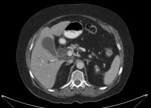 Dilatation of the extrahepatic bile duct in the abdominal CT. Significant dilation of the extrahepatic bile duct is observed, due to obstruction in the distal common bile duct. The intrahepatic bile duct is slightly dilated in some areas, in a liver with regular contours, with no radiological data of chronic liver disease.