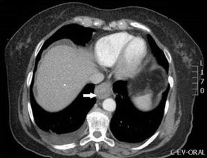 Oesophageal wall thickening.