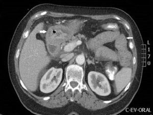 Bowel loop wall thickening.