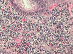 Gastric biopsy with >20eosinophils/field.