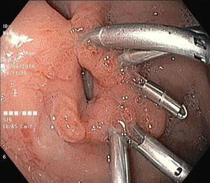Endoscopic image revealing the gastric orifice partially closed with endoclips.