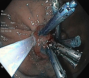 Endoscopic image showing proper placement and tightening of the endoloop around the endoclips.