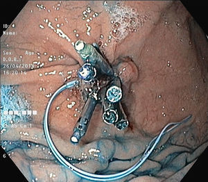 Endoscopic image showing complete closure of the gastric orifice, after releasing the endoloop.