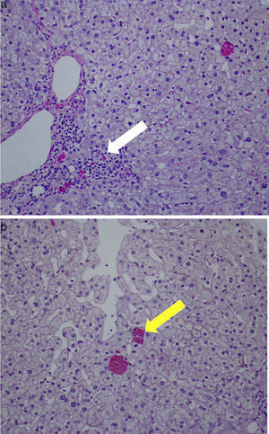(a and b) PAS stain. Histological views ×200 showing portal inflammatory lesions (white arrow) and ceroid-like pigments accumulation in macrophages (yellow arrow).