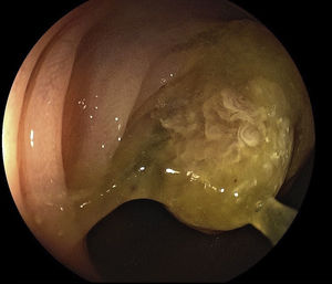 Villous polyp at the hepatic flexure of the colon. A polyp larger than 3cm covered with abundant mucus (0-IIa on the Paris classification) and endoscopically unresectable owing to its size can be seen.