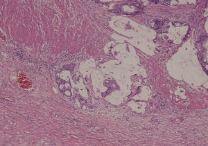 Histological section of the lesion after surgical excision. Tumour invasion of the colon wall's muscular layer as well as cellular atypia and abundant mucin can be seen.
