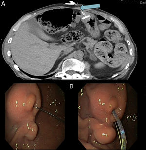 (A) The upper left image of the abdominal CT scan shows the buried bumper. (B) The endoscope image shows the guidewire from the outside through the external tube and the sphincterotome following the guidewire.