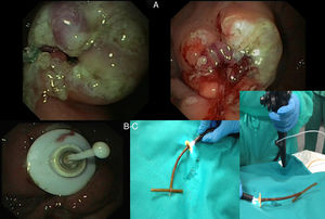 (A) Multiple tangential incisions to the exit port exposing the bumper and enabling it to be dislodged. (B) A polypectomy snare was then fed in and pulled out. A stopper was tied to its end in the form of a “T”, before being pulled back into the gastric cavity, where it dragged the bumper with it to be removed through the mouth. (C) Finally, a guidewire was fed through the gastrostomy opening and removed through the mouth and a Freka® FR 15 tube was inserted.