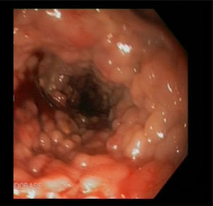 Mucosal involvement shown in the diagnostic colonoscopy that was initially suggestive of hereditary polyposis.