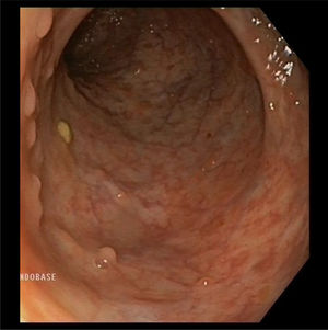 Follow-up endoscopy with conserved mucosal pattern with no signs of inflammation (May 0).