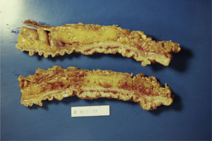 The resected rectosigmoid segment revealed lobulated and polypoid lesions involving full of the circumference.