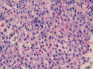 Oesophageal mucosa with squamous epithelium with eosinophilic infiltrate (>20 eosinophils per high-power field).