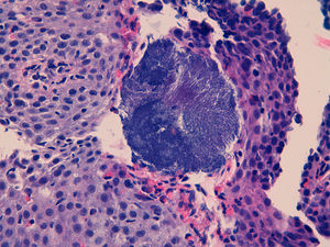 Oesophageal epithelium with eosinophilic infiltrate and surface colonies of Actinomyces.