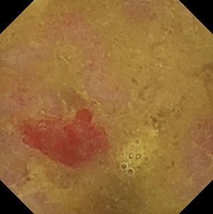 Capsule endoscopy image: vascular lesion consistent with lobular capillary haemangioma.